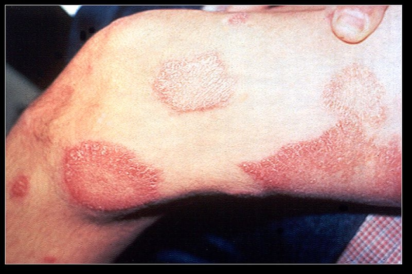  Bőrelváltozások tuberculoid leprás betegben