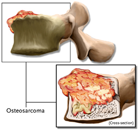 Osteosarcoma csigolyán